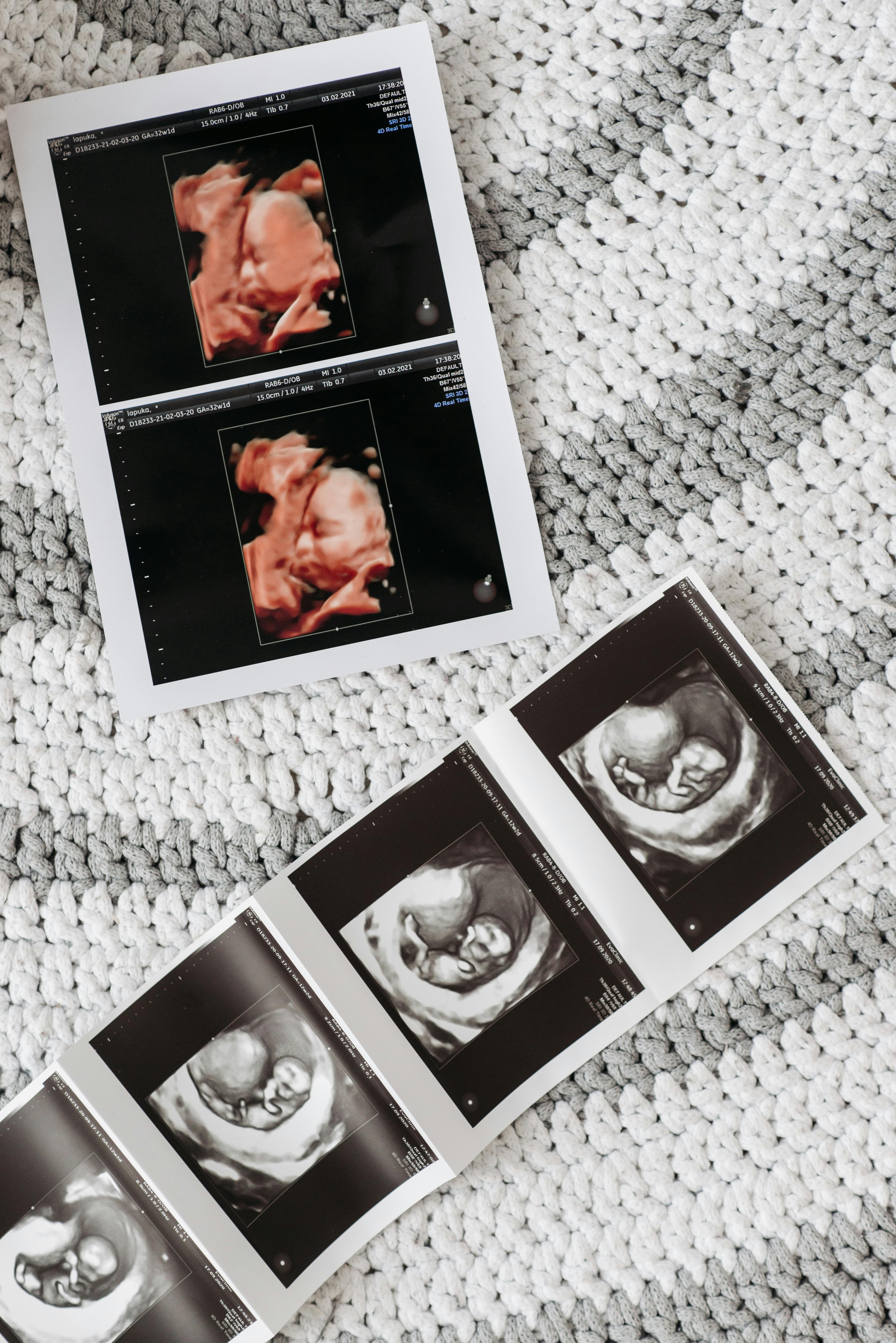 terapia prenatale genetica